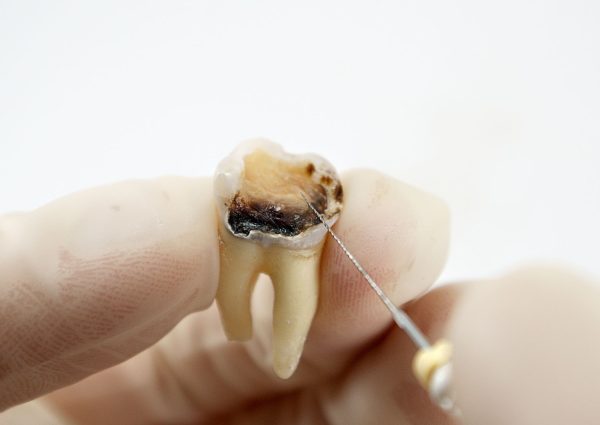 endodontics endodontics