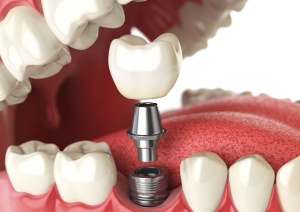 dental implant dental implant